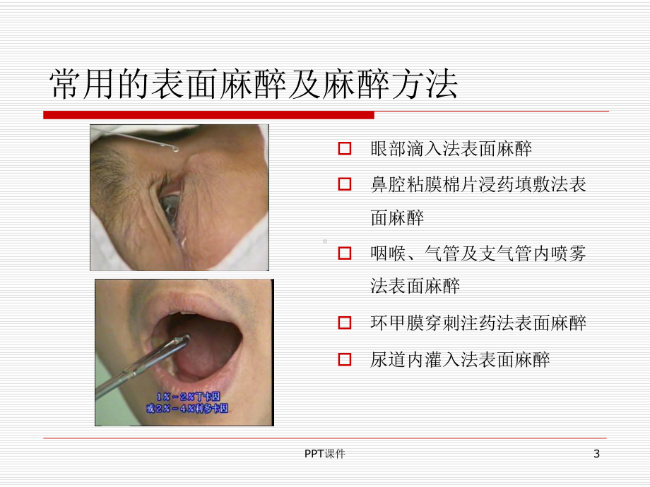 常用局部麻醉方法课件.ppt_第3页