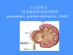 小儿肾积水课件.ppt