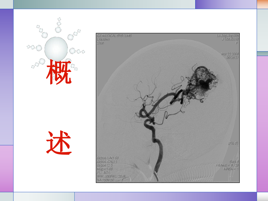 颅内动静脉畸形的治疗与护理课件.ppt_第2页