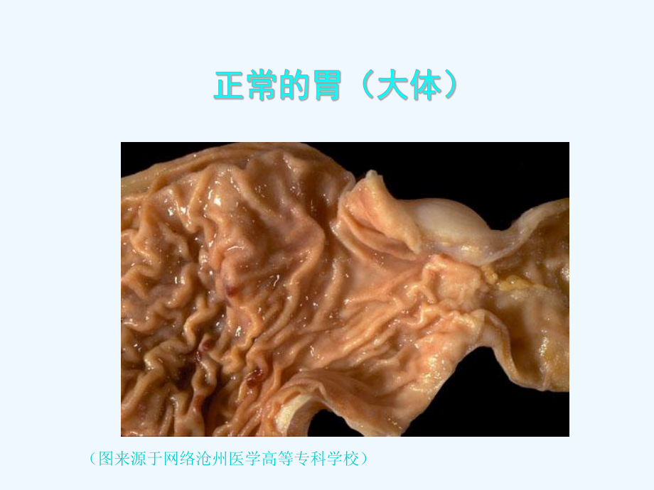 消化性溃疡病理学基础课件.ppt_第3页