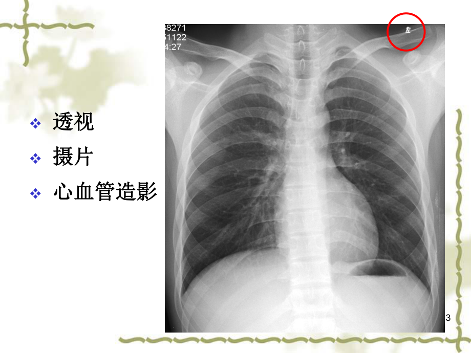 循环系统X线诊断1正常表现课件.ppt_第3页