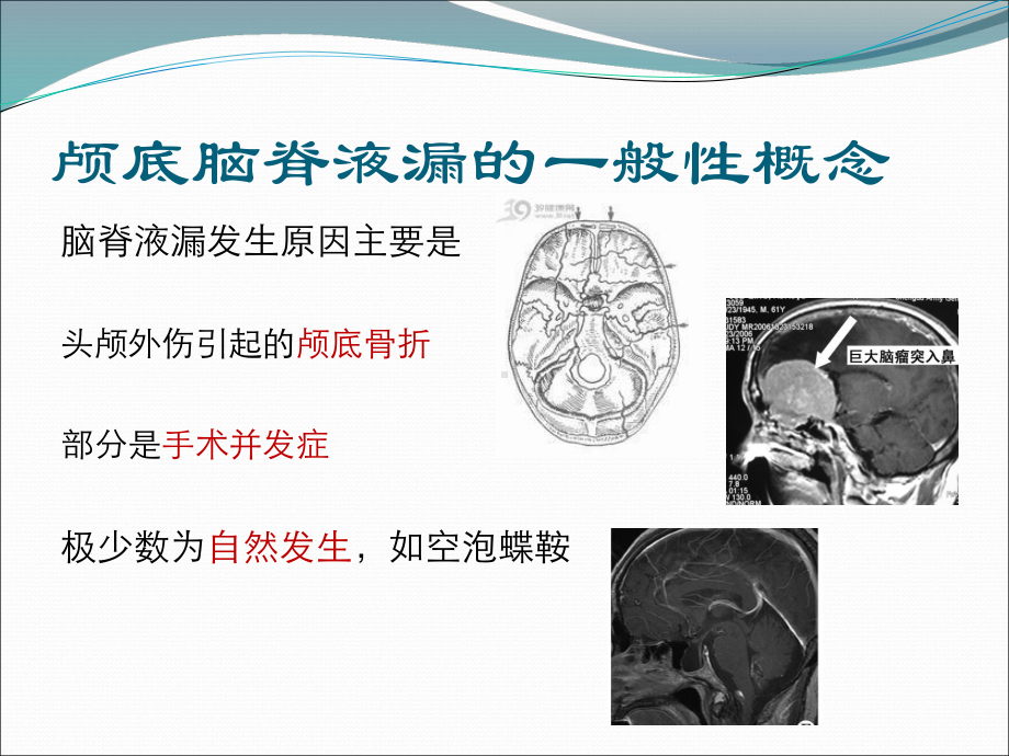 外伤性脑脊液漏治疗策略课件.ppt_第3页