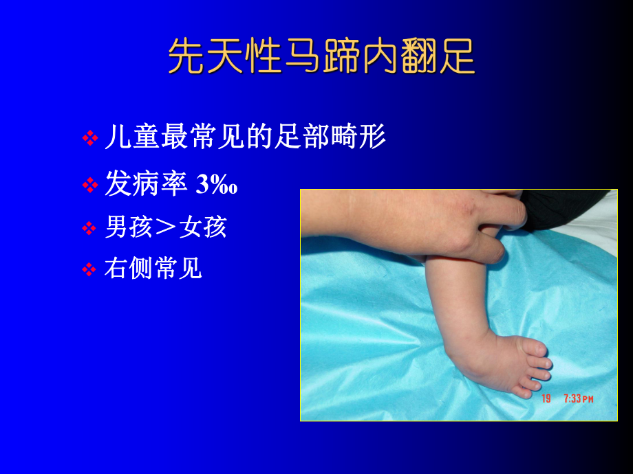 先天马蹄内翻足治疗课件.ppt_第2页