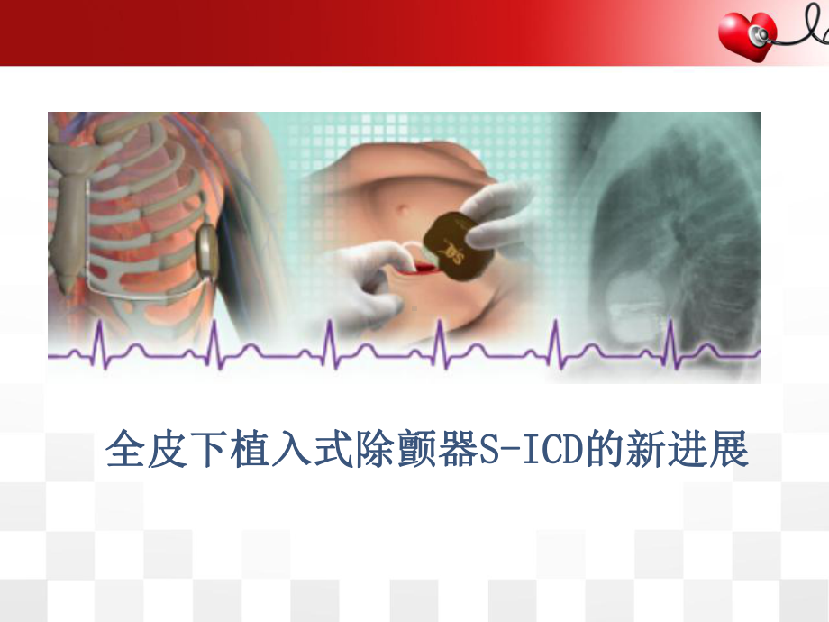 全皮下植入式除颤器SICD的新进展医学课件.pptx_第1页