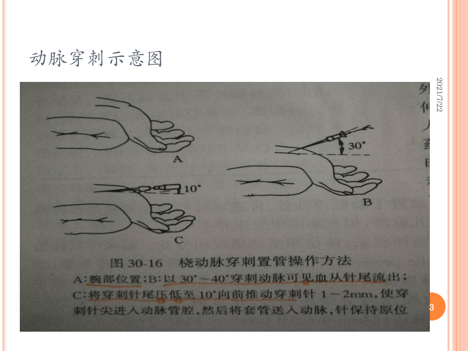 动脉穿刺置管与血压测定课件.pptx_第3页