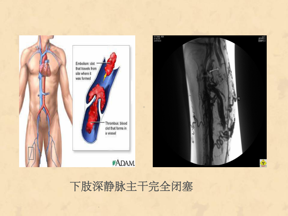 下肢静脉血栓的相和关知识护理课件.ppt_第3页