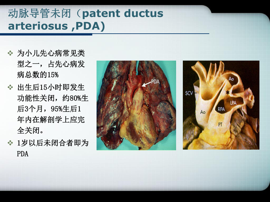 PDA(动脉导管未闭)课件.ppt_第2页