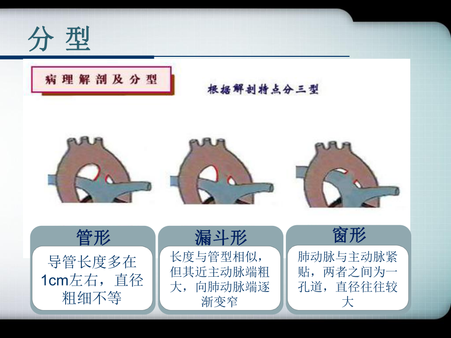 PDA(动脉导管未闭)课件.ppt_第3页