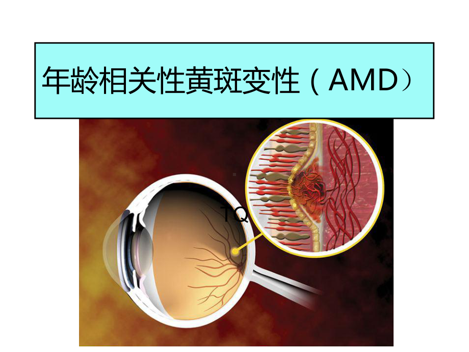 6、amd年龄相关性黄斑变性课件.ppt_第1页