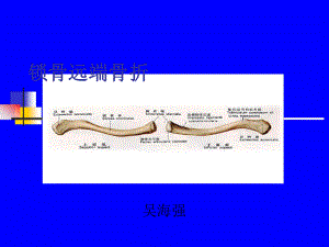 32锁骨远端骨折课件.ppt