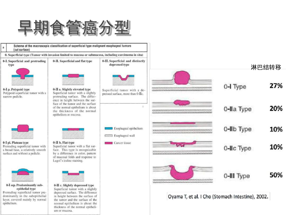 NBI+放大在食管早癌诊断中应用进展课件.ppt_第3页