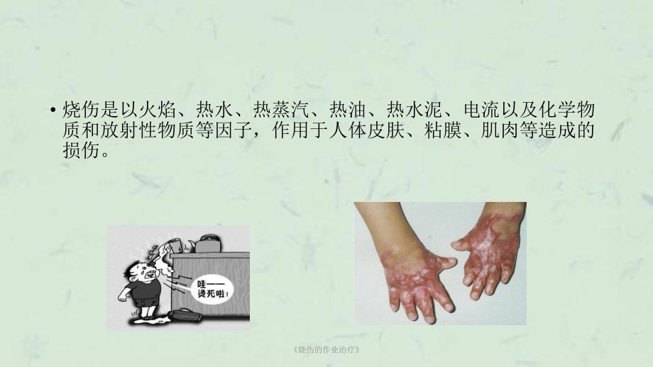 《烧伤的作业治疗》课件.ppt_第2页