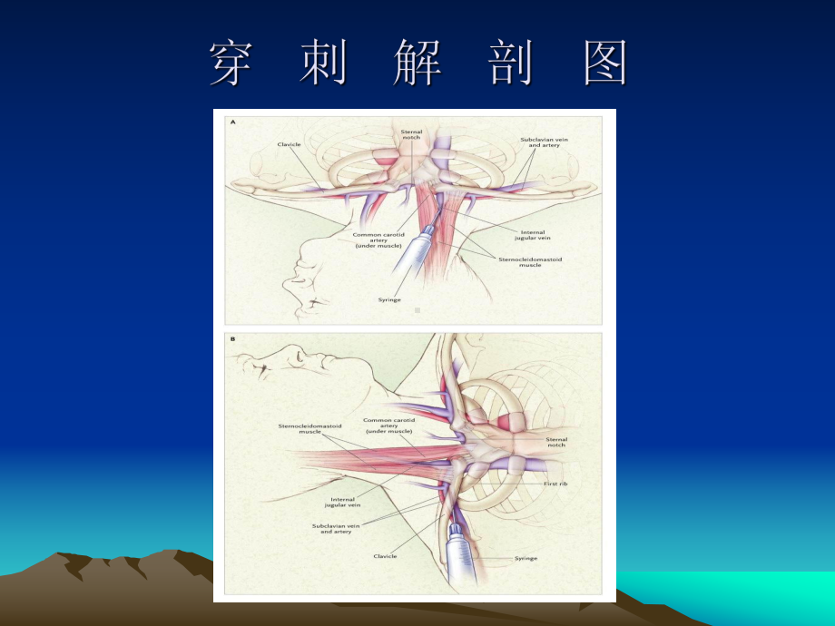 中心静脉穿刺插管术222222222222课件.ppt_第2页