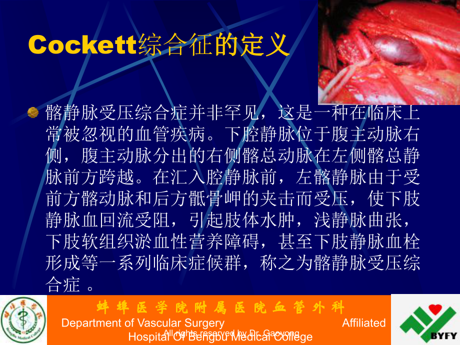 Cockett综合症的诊断与治疗课件.ppt_第3页