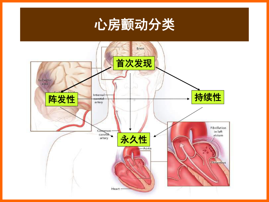 (课件)从2006年ACCAHAESC指南看心房颤动治疗规范化与进展.ppt_第2页