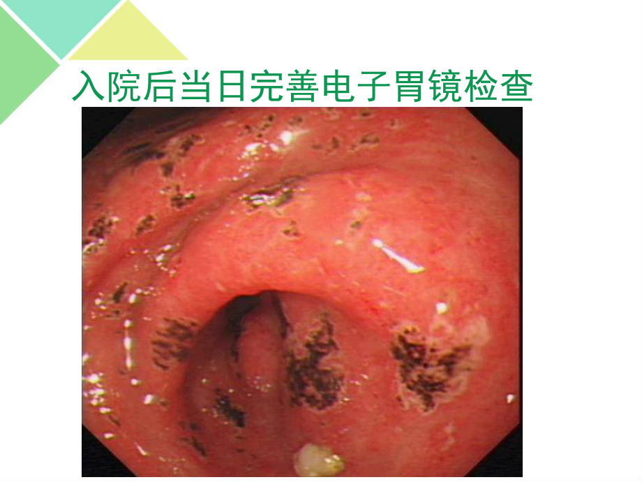 nasids相关胃肠道损伤的ppi临床应用课件.ppt_第3页