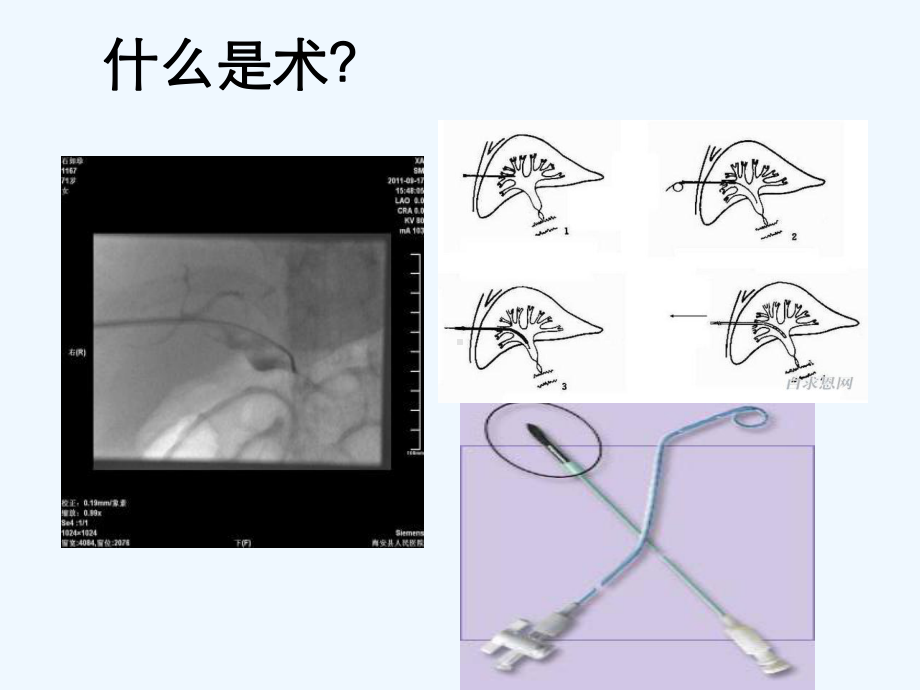 PTCD引流管的护理课件.ppt_第3页