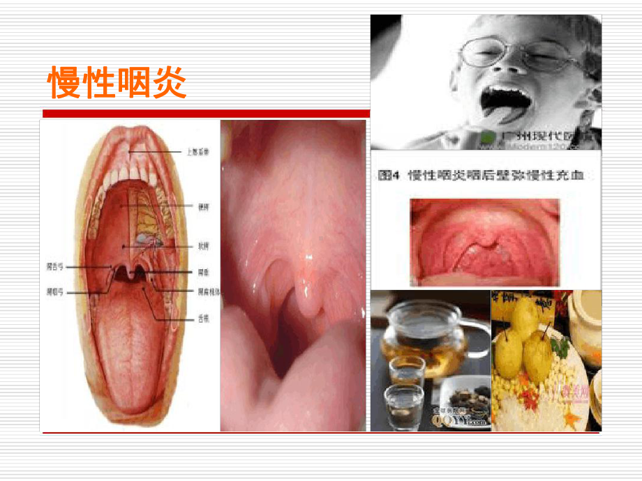 中医药与健康慢性咽炎亚健康课件.ppt_第3页