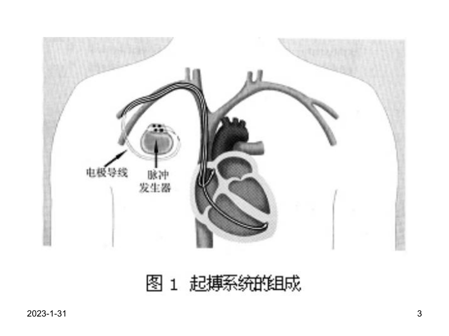 丁主任人工心脏起搏器与麻醉(简版)课件.ppt_第3页