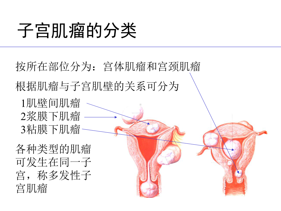 (课件)子宫肿瘤第一节子宫肌瘤Myomaofuterus1.ppt_第3页