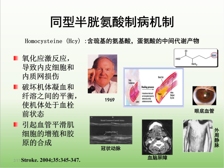 H型高血压防治措施医学教学课件.ppt_第2页