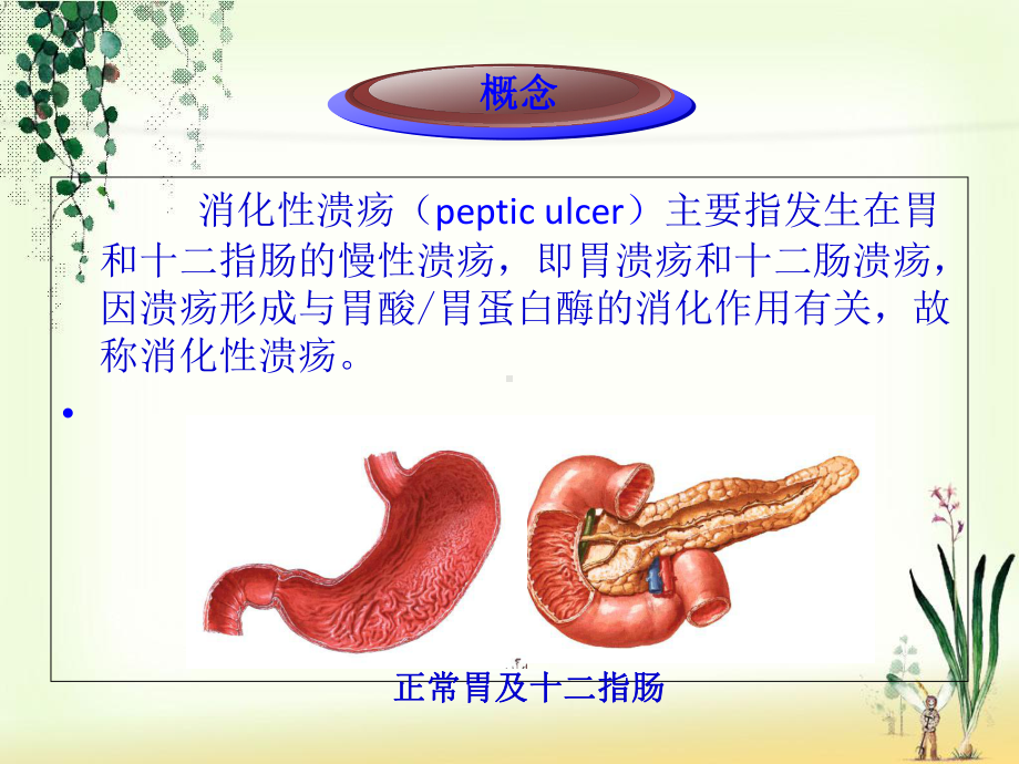 一份消化性溃疡胃镜下表现及护理课件.ppt_第3页