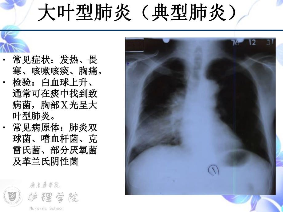 SARS病人的护理课件.ppt_第3页