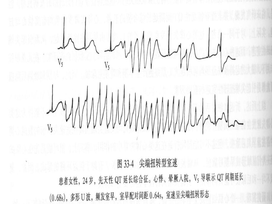 QT间期延长综合征课件.ppt_第3页