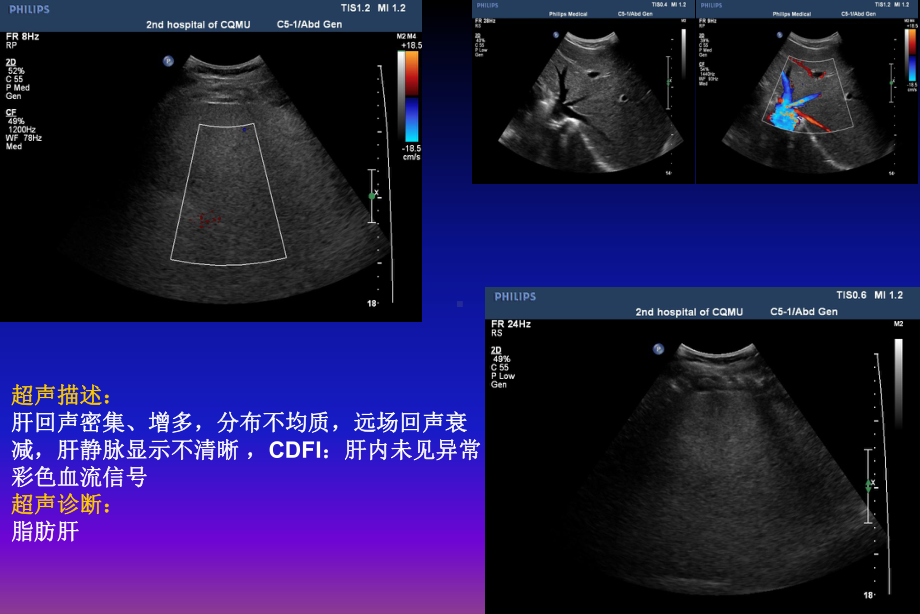 (超声诊断学)18腹部与小器官常见疾病课件.ppt_第3页
