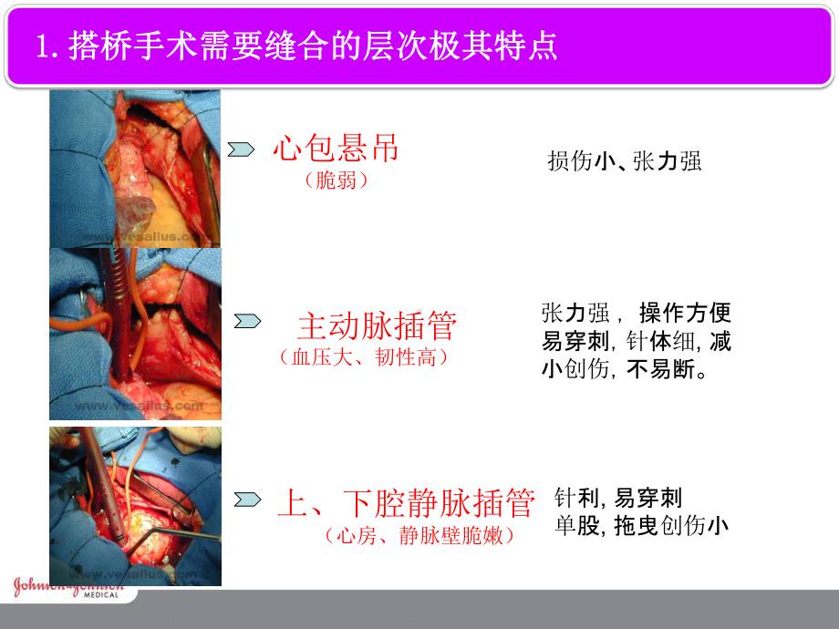 CV搭桥对针线的选择课件.ppt_第3页