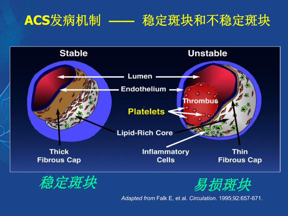 ACS抗栓治疗与出血预防3111课件.ppt_第2页