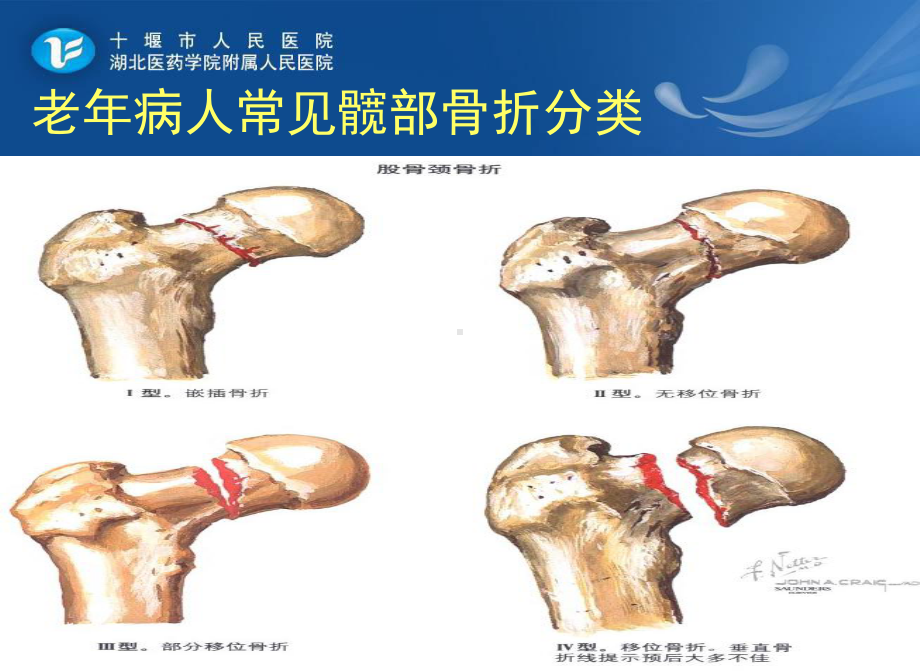 2老年髋部骨折患者的护理课件.ppt_第3页