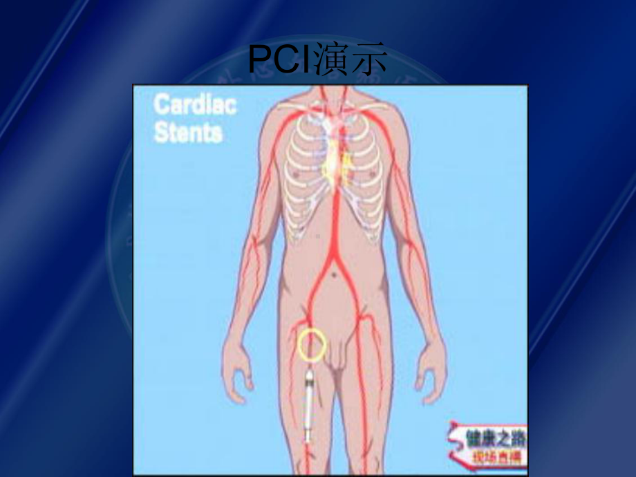 PCI术后并发症的观察与护理解读课件.ppt_第3页