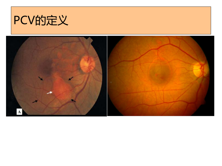 7pcv息肉状脉络膜血管病变课件.ppt_第3页