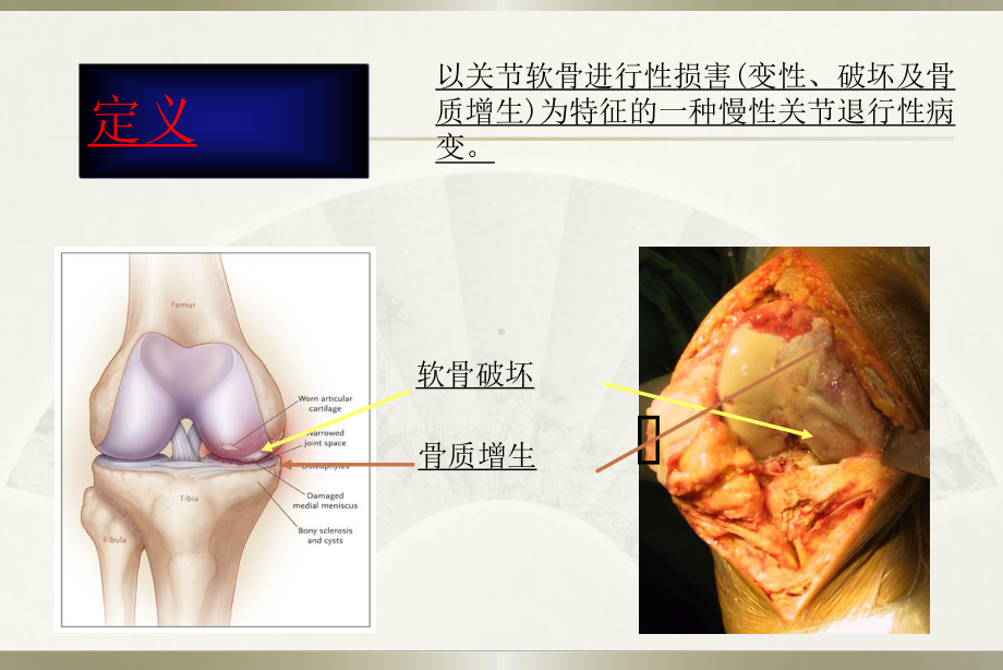 OA治疗新进展课件.ppt_第3页