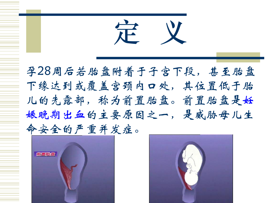 5前置胎盘病人的护理课件.ppt_第3页