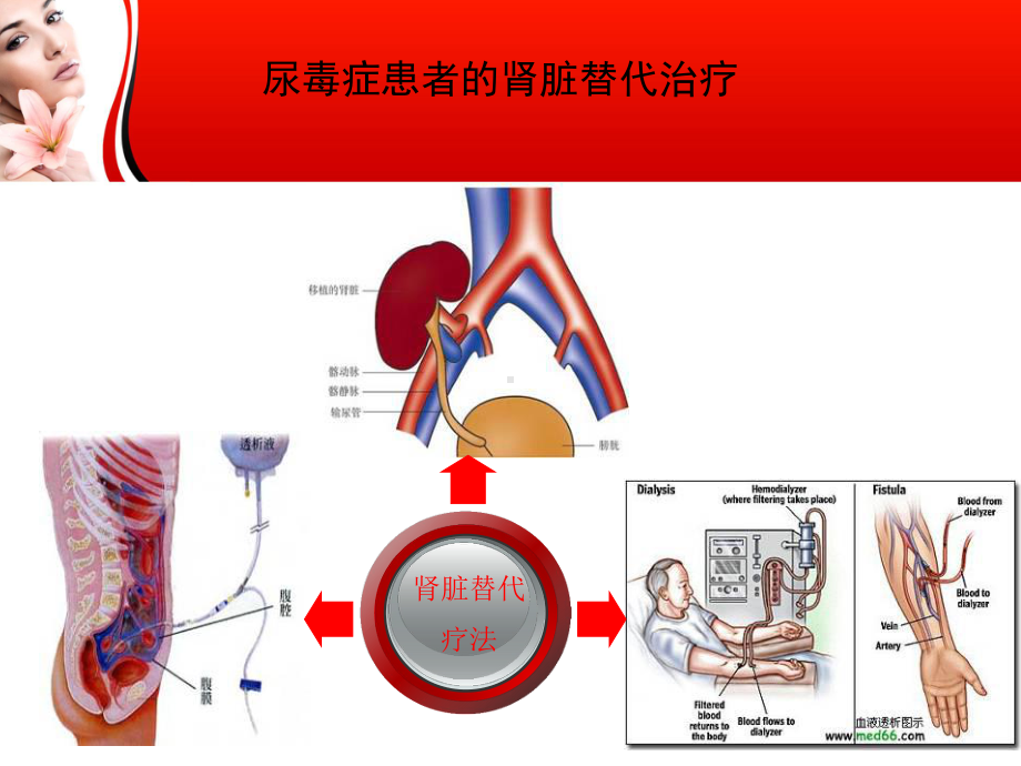 血液透析并发症之肾性贫血课件.ppt_第3页