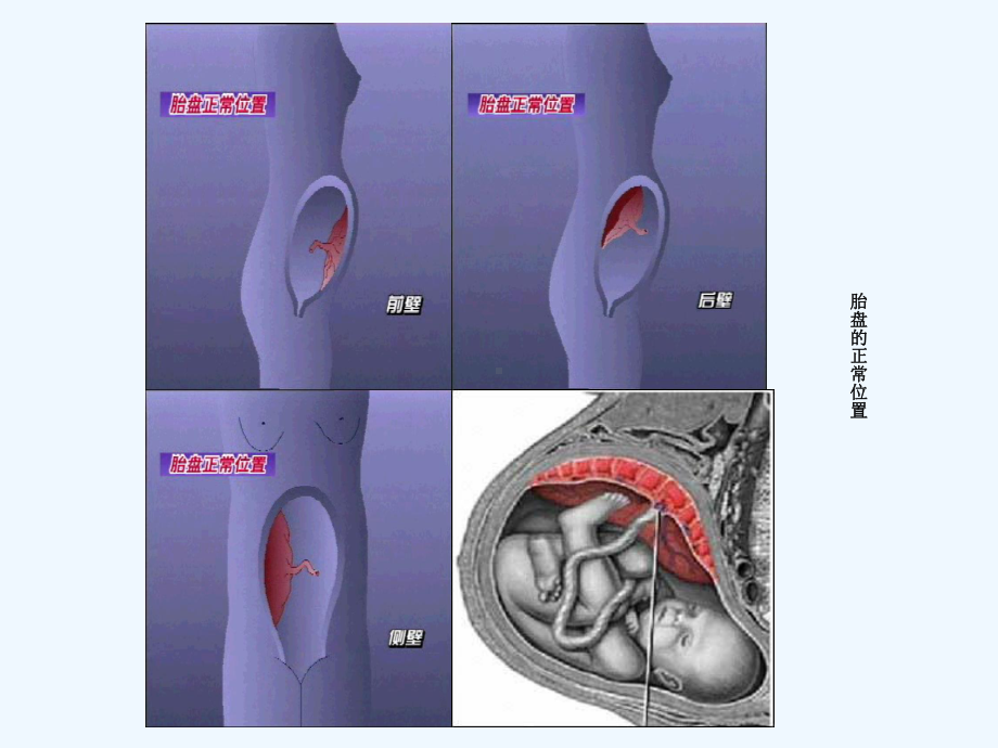 妇产科学课件前置胎盘.ppt_第2页