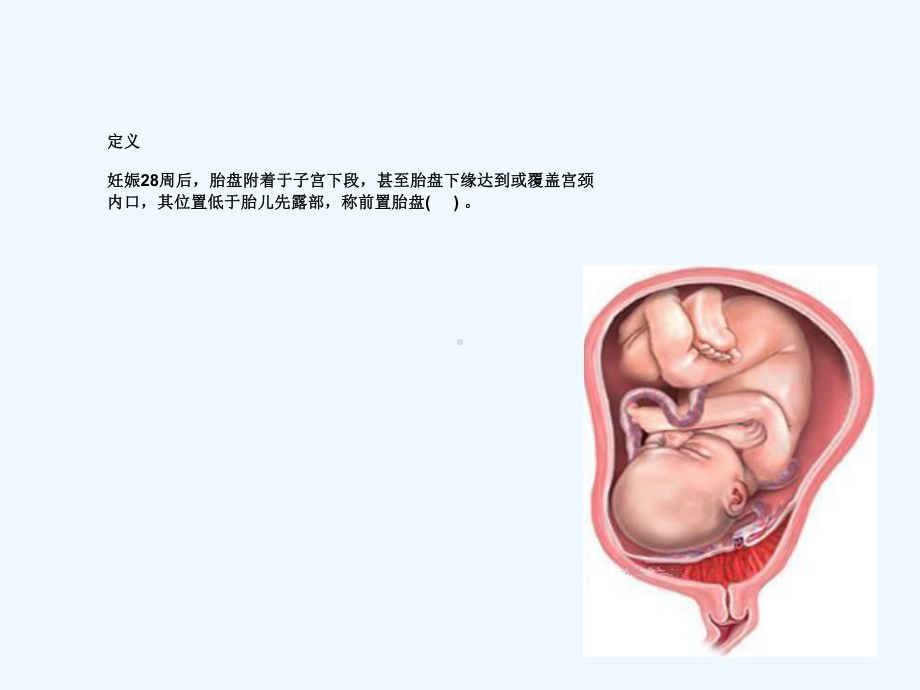 妇产科学课件前置胎盘.ppt_第3页