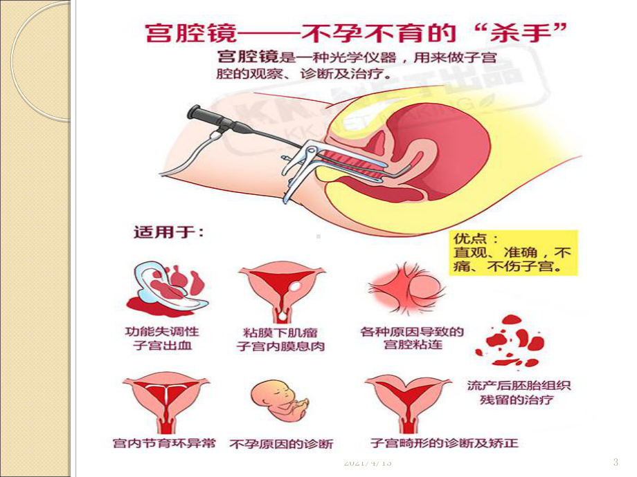 宫腔镜在妇科临床应用基础知识课件.ppt_第3页