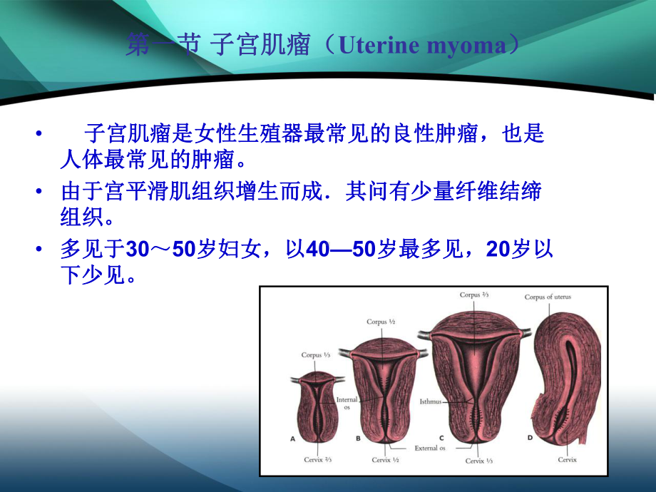 子宫肌瘤、子宫内膜癌课件.ppt_第3页