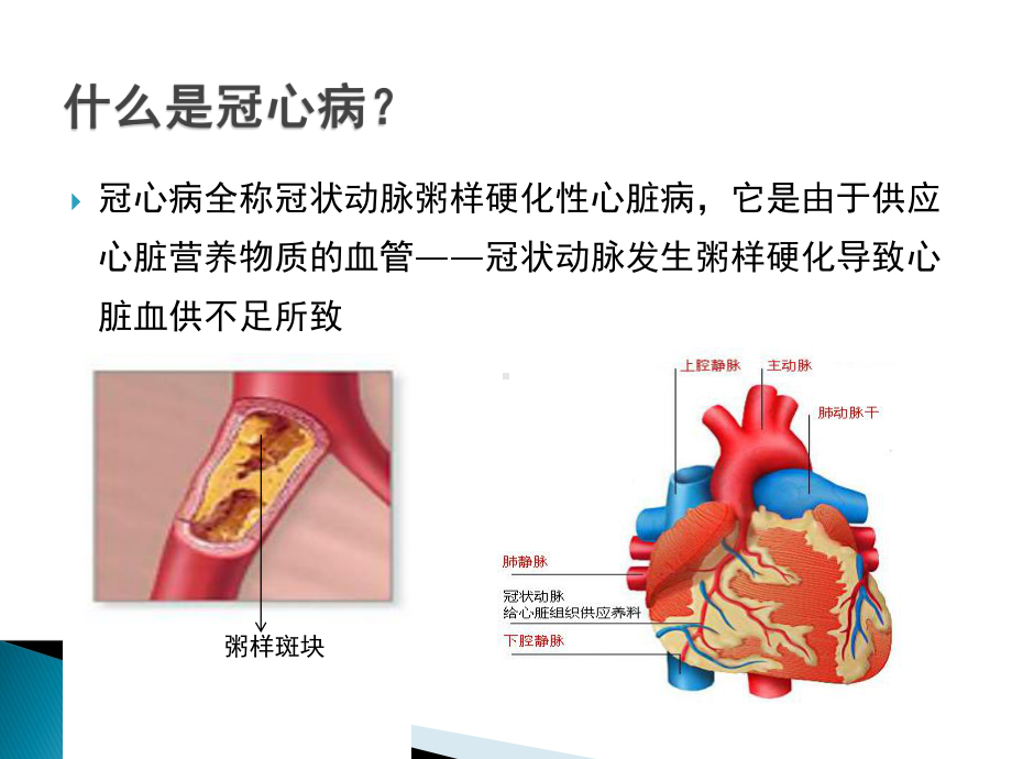 冠心病的介入治疗课件.pptx_第3页