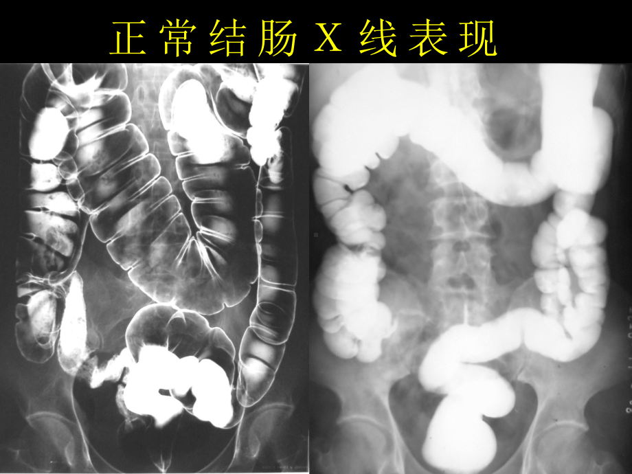 结直肠肿瘤的影像诊断 课件1.ppt_第2页