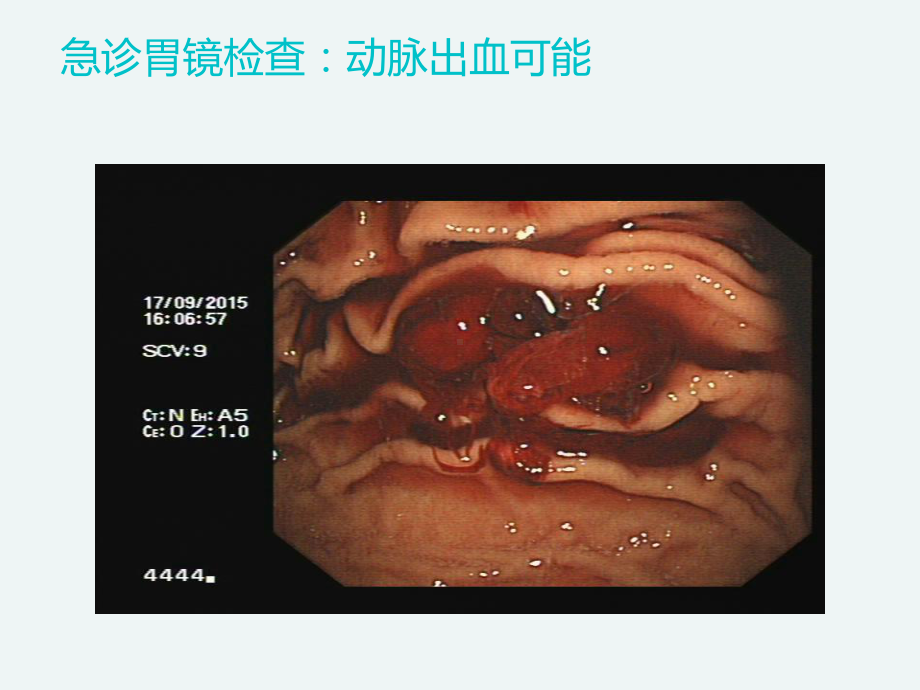 急诊急性消化道出血课件.ppt_第3页