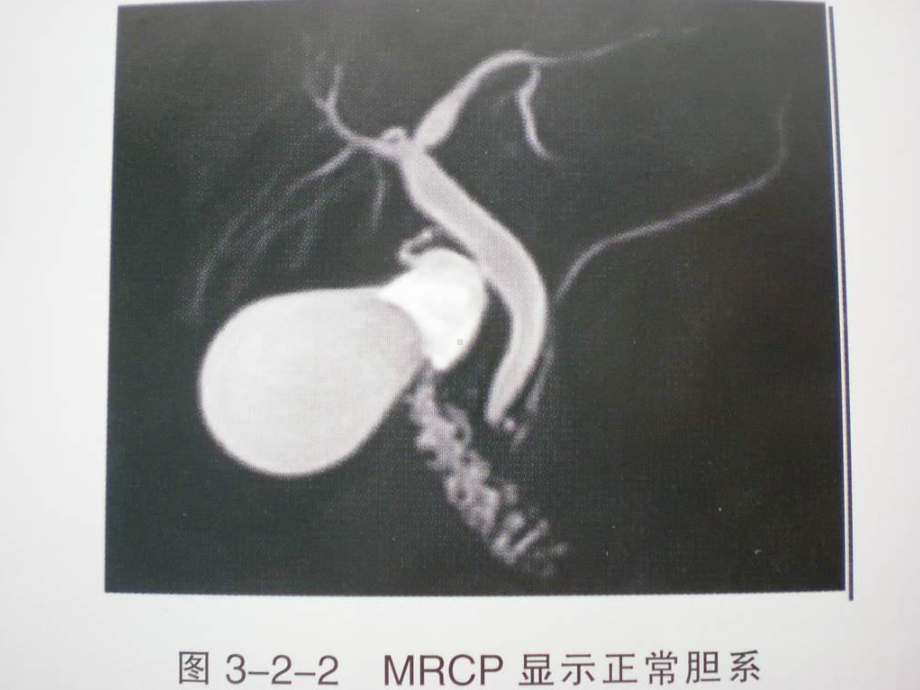 磁共振胰胆管成像 课件.ppt_第3页