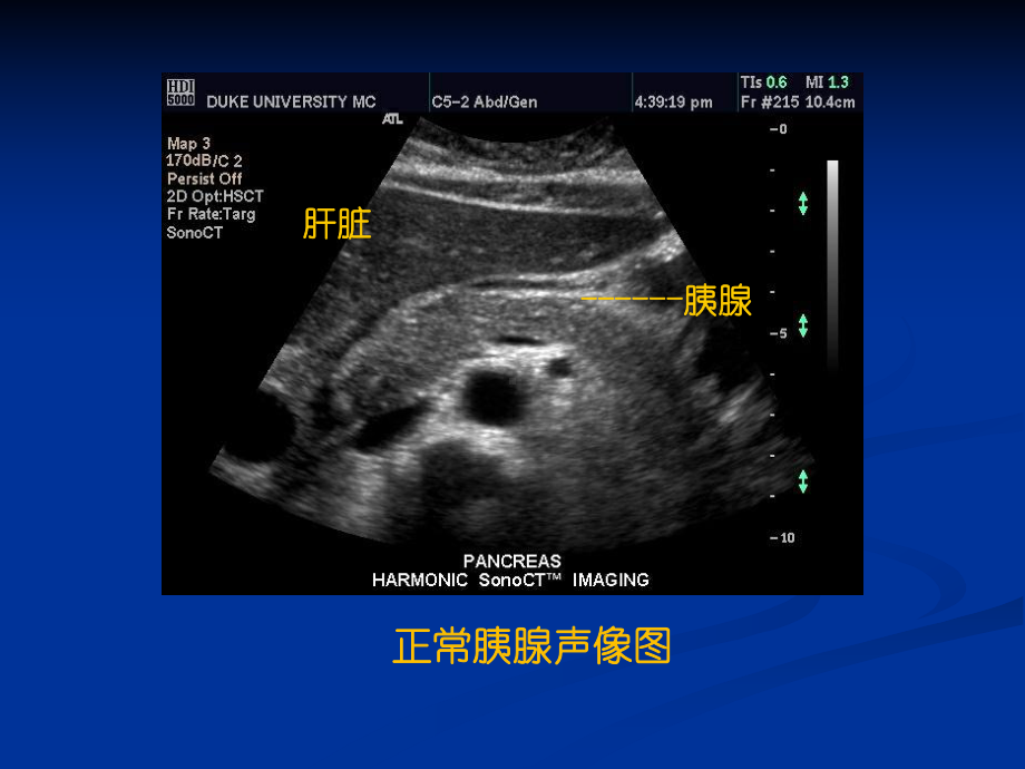 超声腹部2胰脾超声1学时课件.ppt_第3页