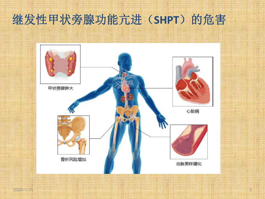 继发性甲旁亢治疗的思考溉纯和胜普乐的临床有效性简约版精编课件.pptx_第3页