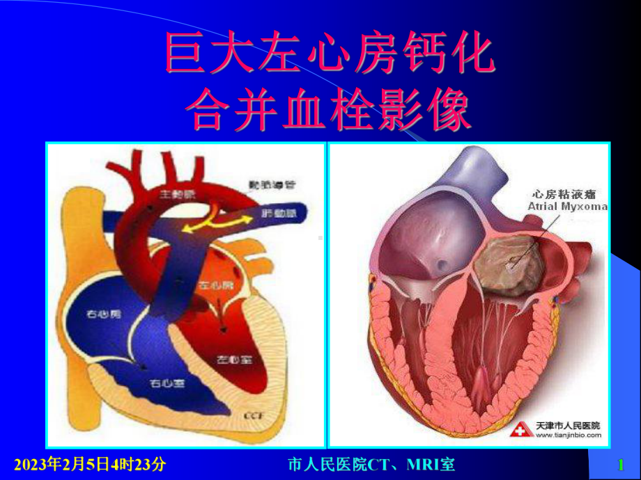 巨大左心房钙化合并血栓影像课件.ppt_第1页