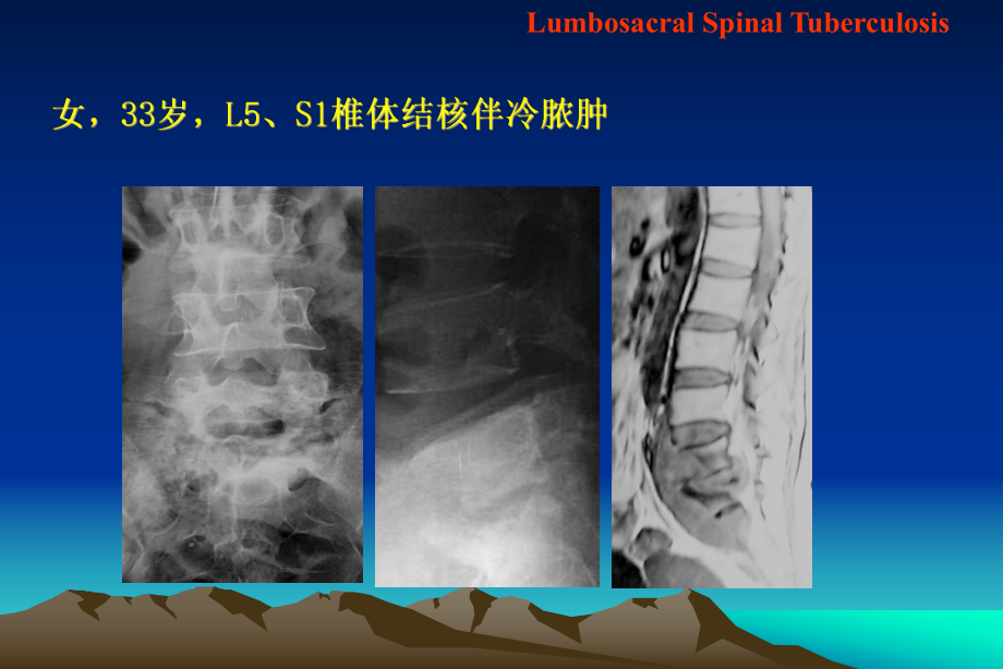 第五章骨痨课件.ppt_第2页