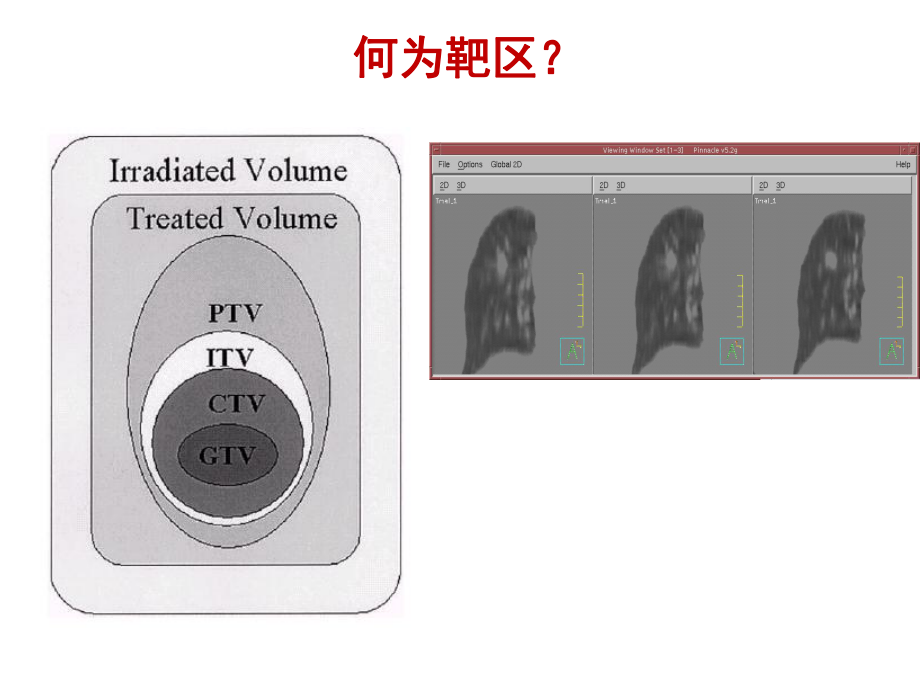 肺癌的靶区勾画肿瘤学基地讲课课件.ppt_第3页